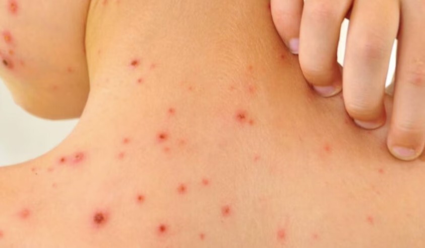 Brote de sarampión en México: registraron 9.074 casos, el mayor índice de América