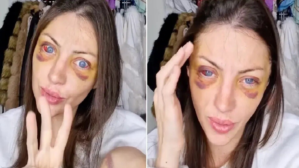 Conmoción por la muerte de una influencer que se sometió a 27 cirugías para parecer una Barbie