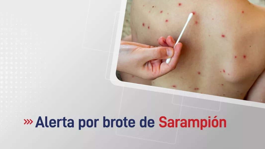 100318-recomendaciones-ante-la-alerta-epidemiologica-por-sarampion-en-el-pais.webp Recomendaciones ante la alerta epidemiológica por sarampión en el país