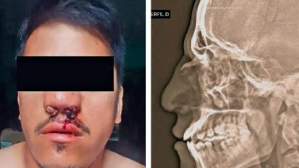 FUTBOL AMATEUR EN MACO: LE FRACTURARON LA NARIZ A UN ÁRBITRO LORETANO