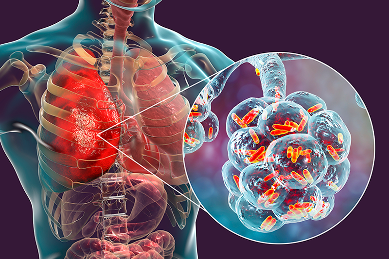Legionella en verano: el riesgo en hoteles y spas