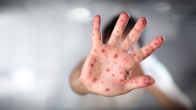 dd2deea3d0cdeda739f66b0e938b60e3_L.jpg El Ministerio de Salud de la provincia de San Juan brinda algunas recomendaciones para prevenir el sarampión