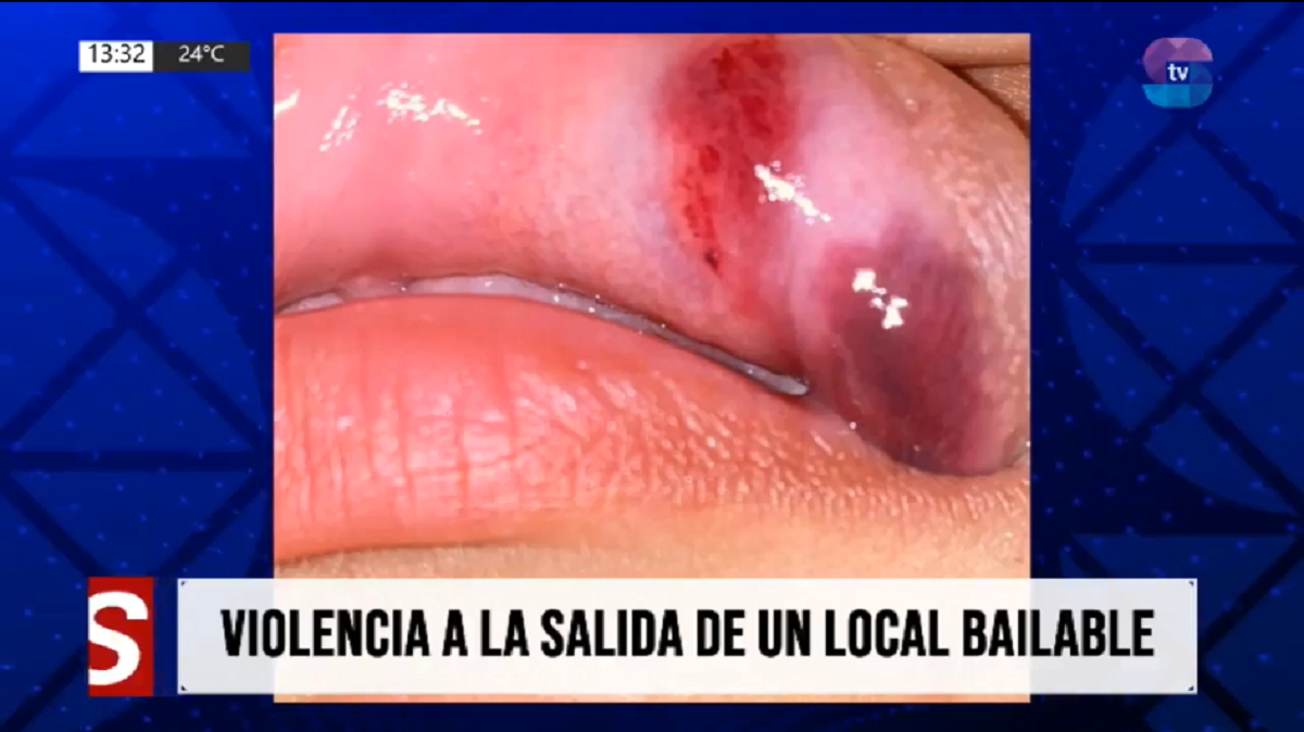 golpe.png Brutal ataque en patota a la salida de un boliche: una joven denunció a nueve mujeres