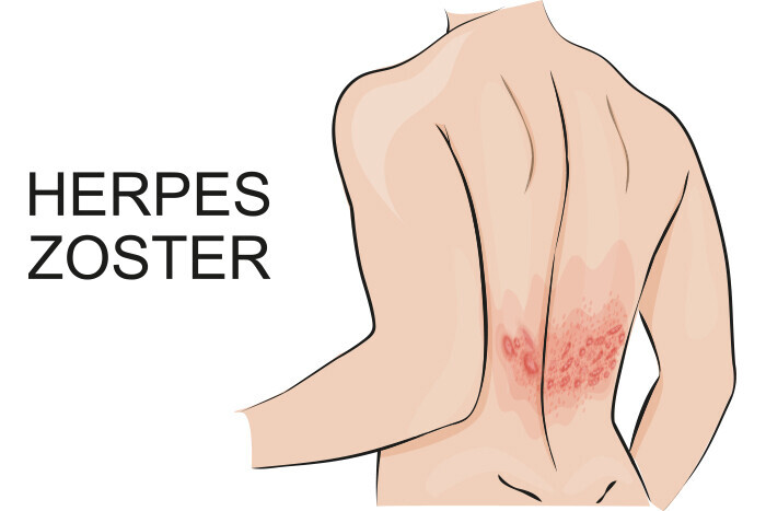 herpes-zoster.jpg