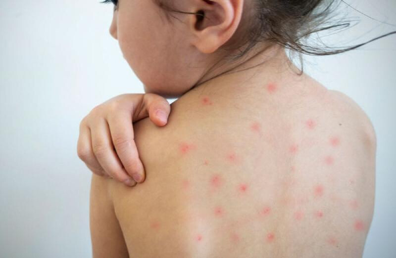 imagen_72006.jpg Formosa en alerta por aumento de casos de sarampión notificados en Paraguay