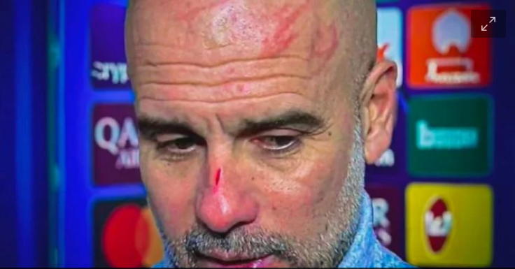 Guardiola se vuelve viral por heridas en el rostro tras empate en Champions: ‘Me quería hacer daño’
