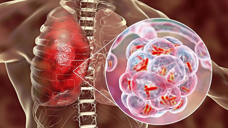 TUBERCULOSIS EN ARGENTINA: AUMENTAN LOS CASOS Y REFUERZAN LAS MEDIDAS PARA DETECTAR LA ENFERMEDAD