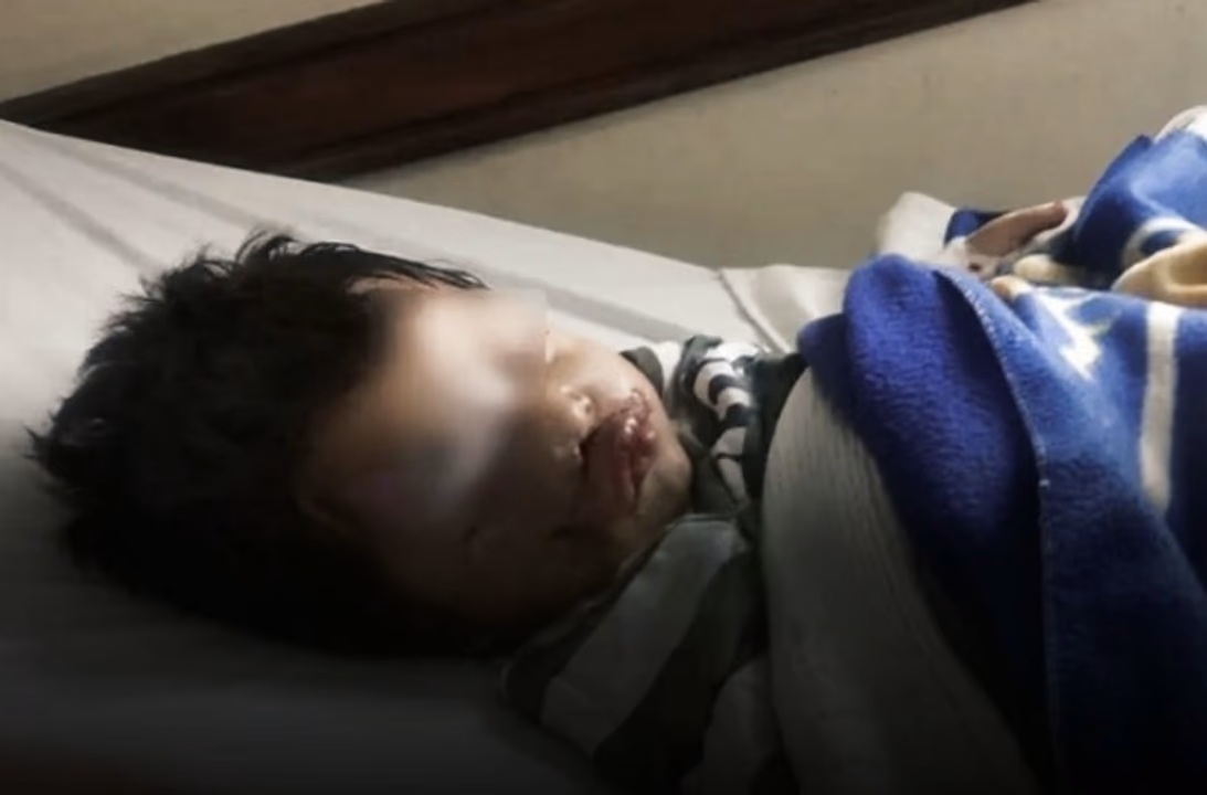 UN NENE DE 3 AÑOS FUE ATACADO POR UN PERRO EN SALTA Y SU FAMILIA PIDE AYUDA