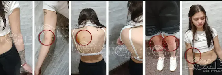 las-lesiones-de-victoria-luz-cantero-al-momento-de-su-detencion-foto-gentileza-diario-norte-FXR26QU2H5FGJL6VVZ7W7ZT47Y.webp